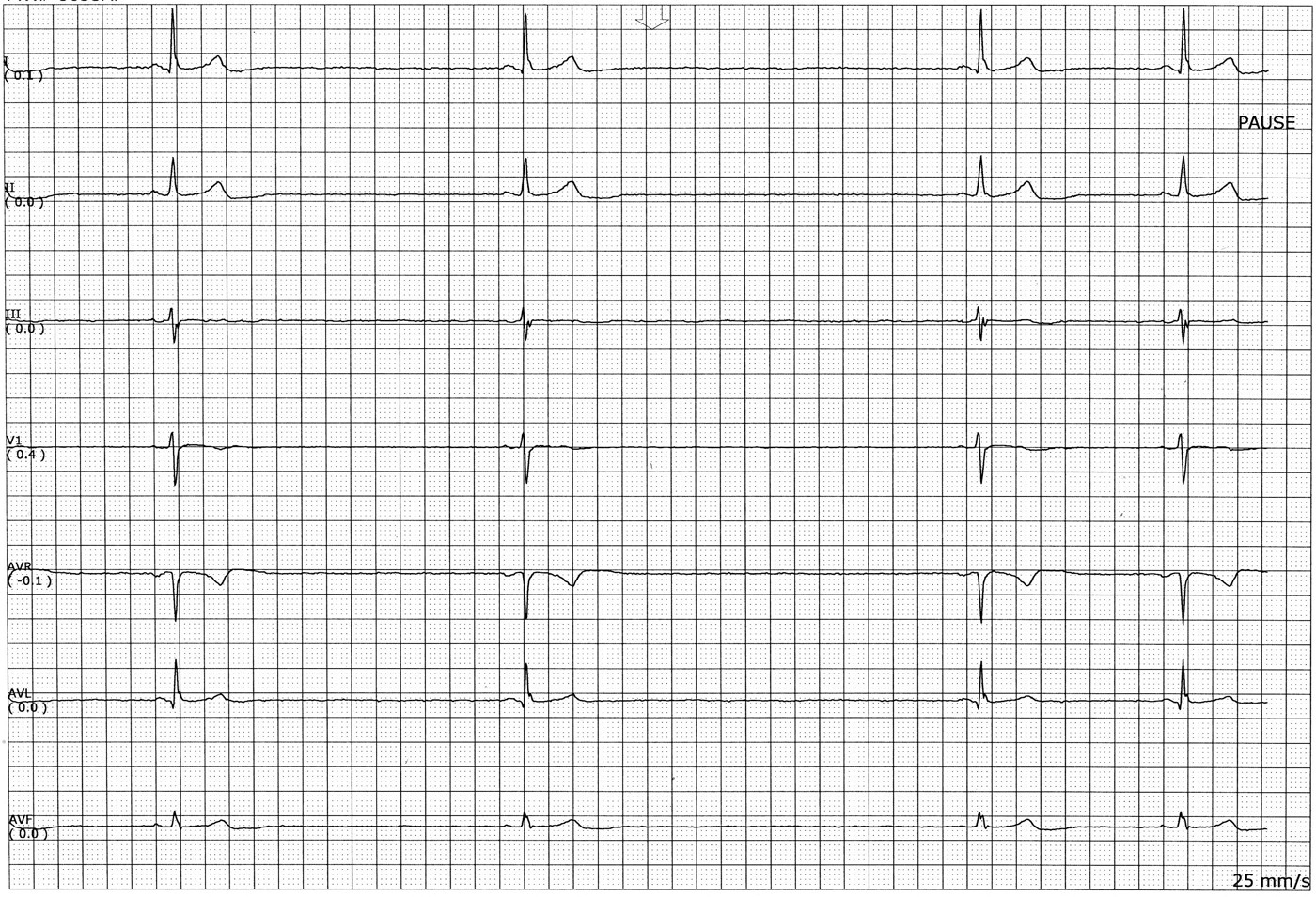 Clinical ECG recording showing sinus rhythm and a labelled sinus pause